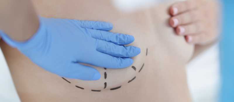 woman breast markings surgery