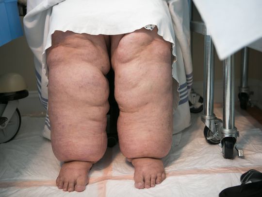 Lipedema
