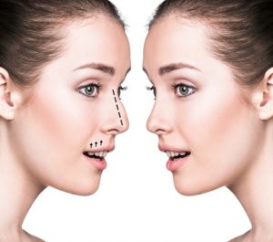 rinoplastia