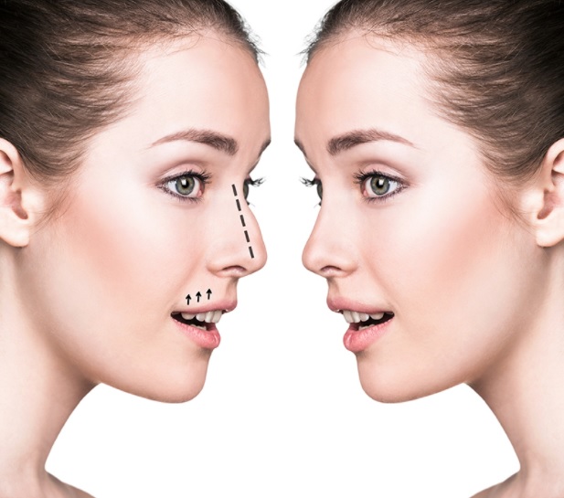 rinoplastia